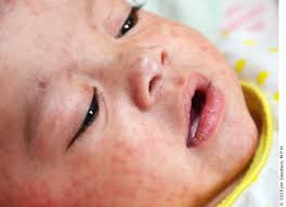 child with measles rash